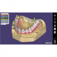 Exocad Implant Module - модуль для создания имплантов | Exocad (Германия)